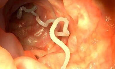 parazitų atsiradimo žmogaus organizme priežastys